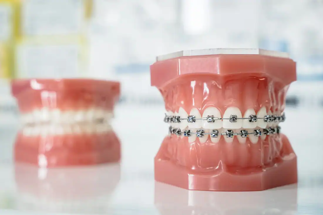 A close up of a tooth with braces on it