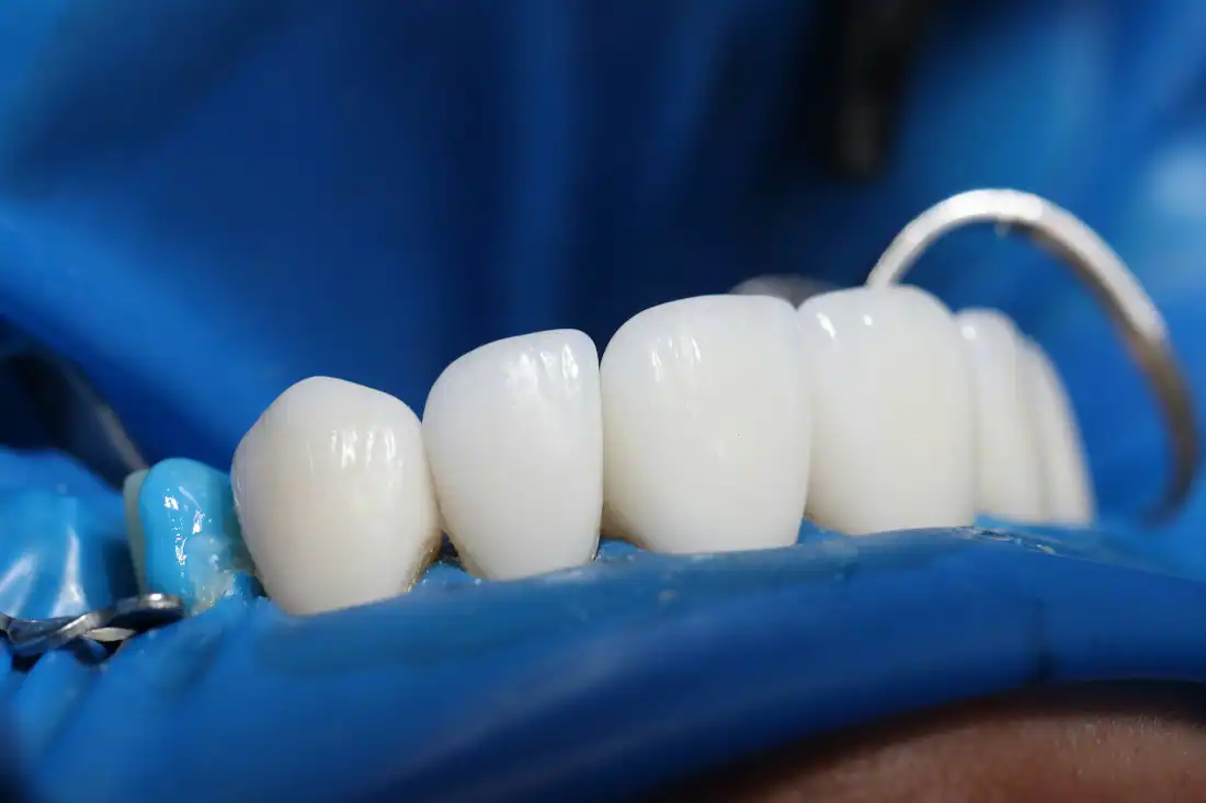 A close-up view of a same day crown