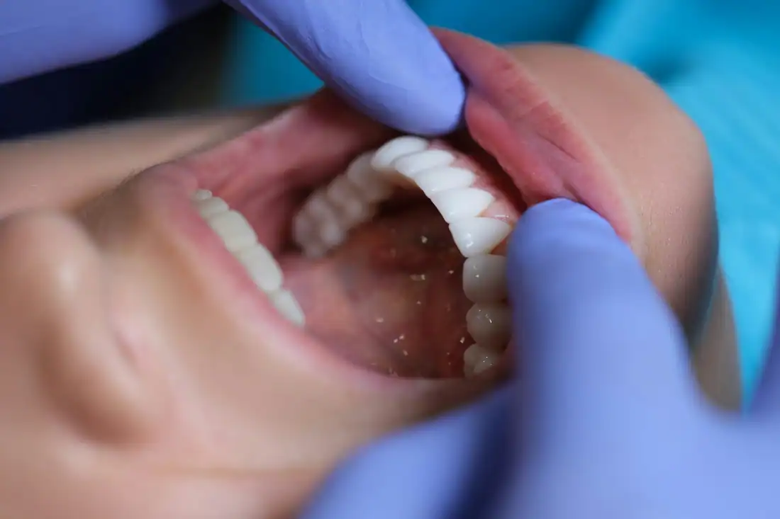 Dental Crown Maintenance