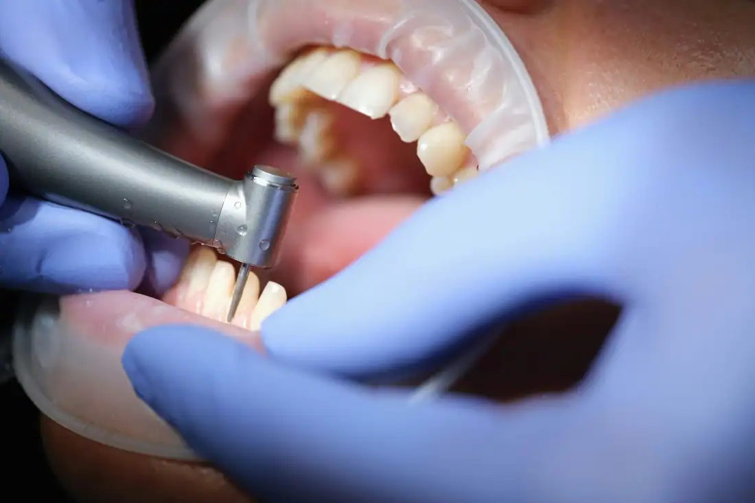 applying same-day dental crowns