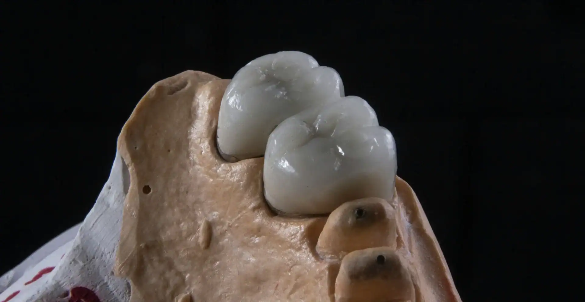 Caring for Same Day Crowns: Tips for Long-Lasting Results