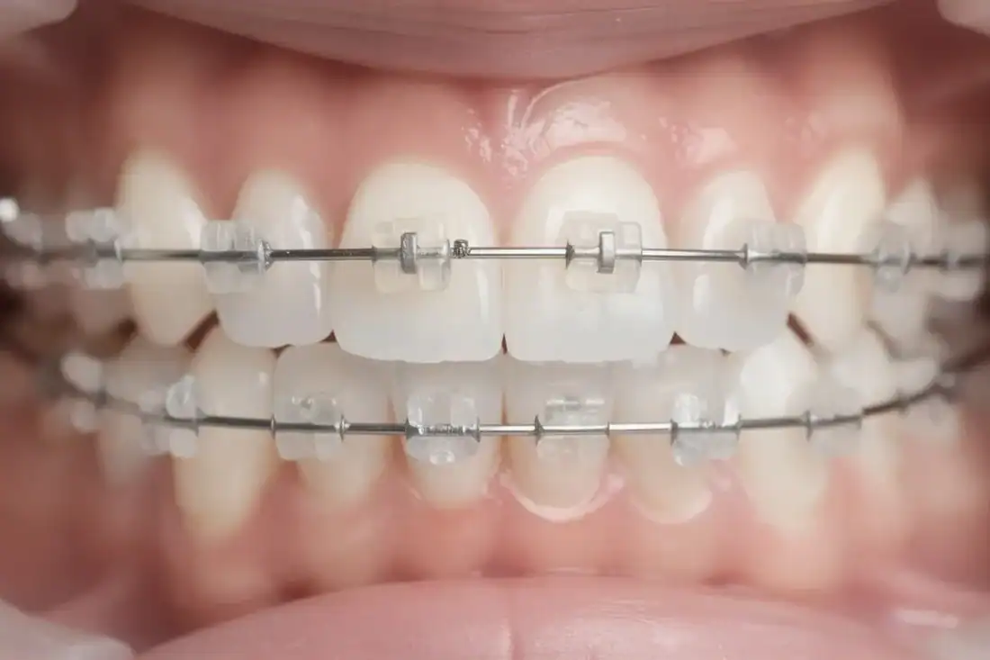 Ceramic or Clear Braces