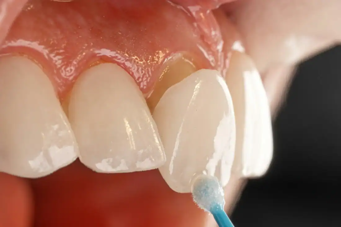 Dental Bonding being implemented