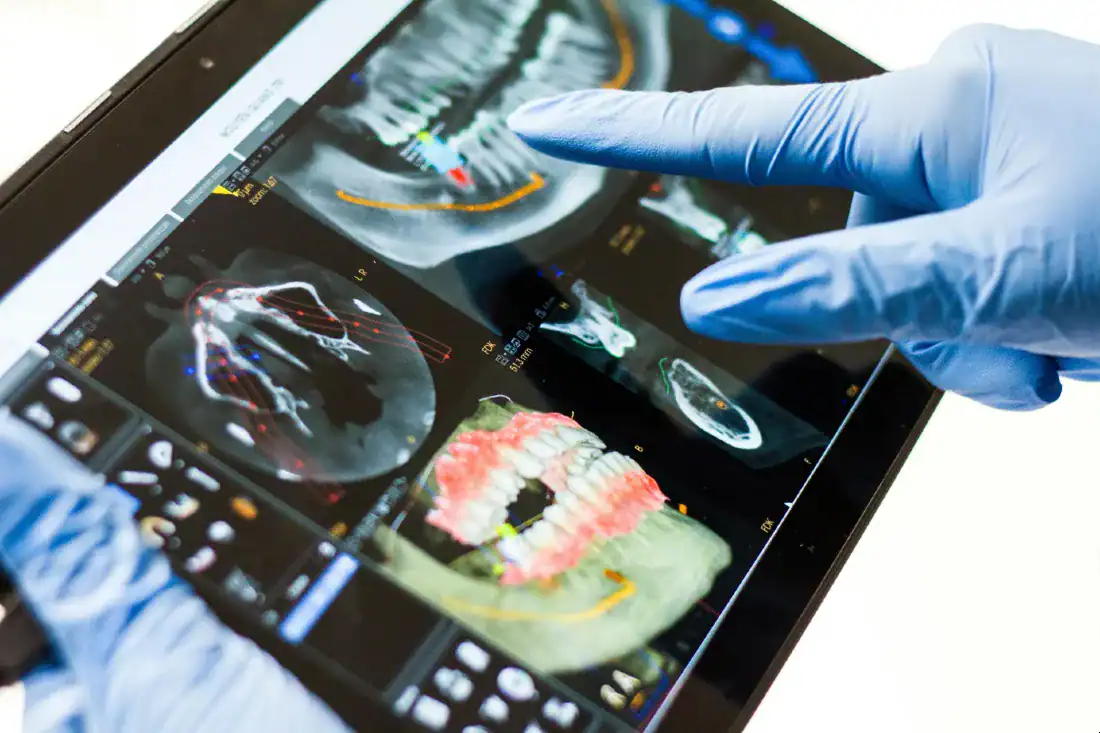 Dental X-ray displayed on a monitor in a clinic
