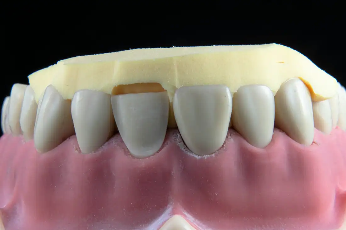 full mouth dental implants