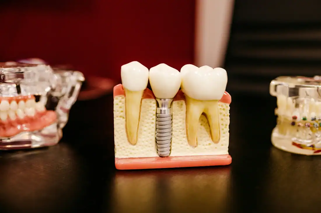 dental implant model