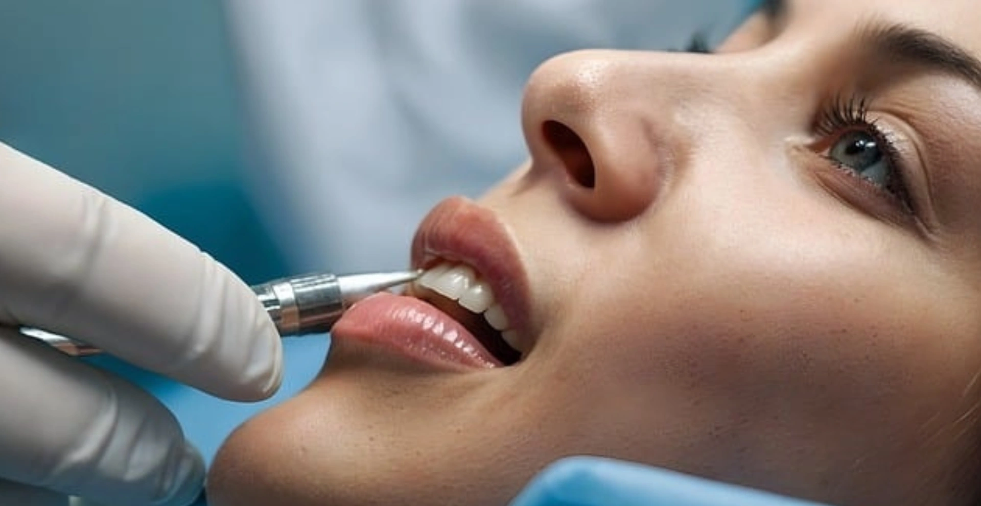 How Are Veneers Done?