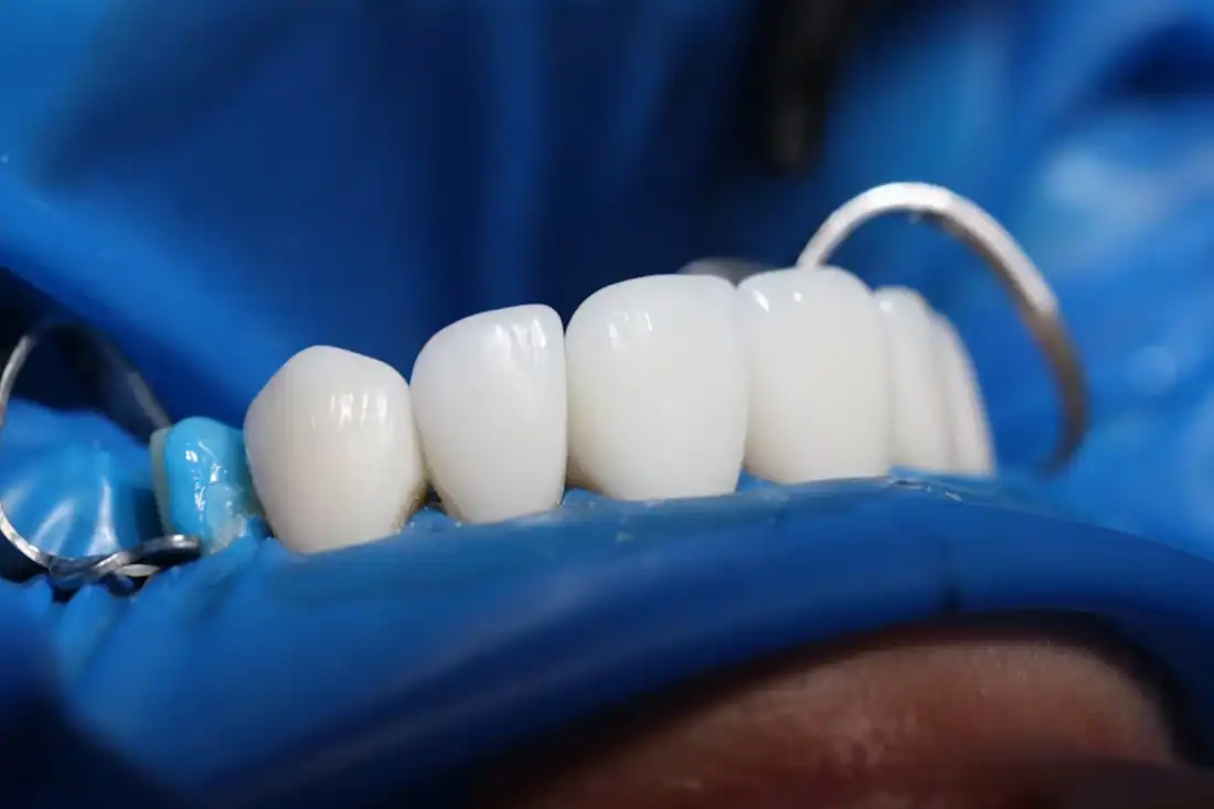 cerec crown being created by dentist using machine