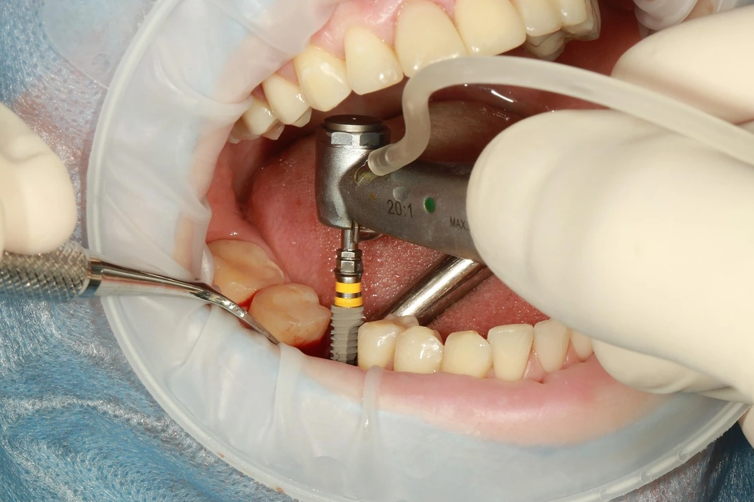 Dental Implant procedure