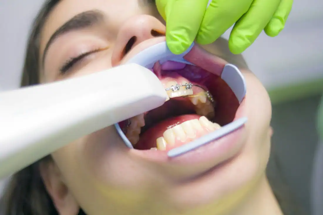 metal braces being applied