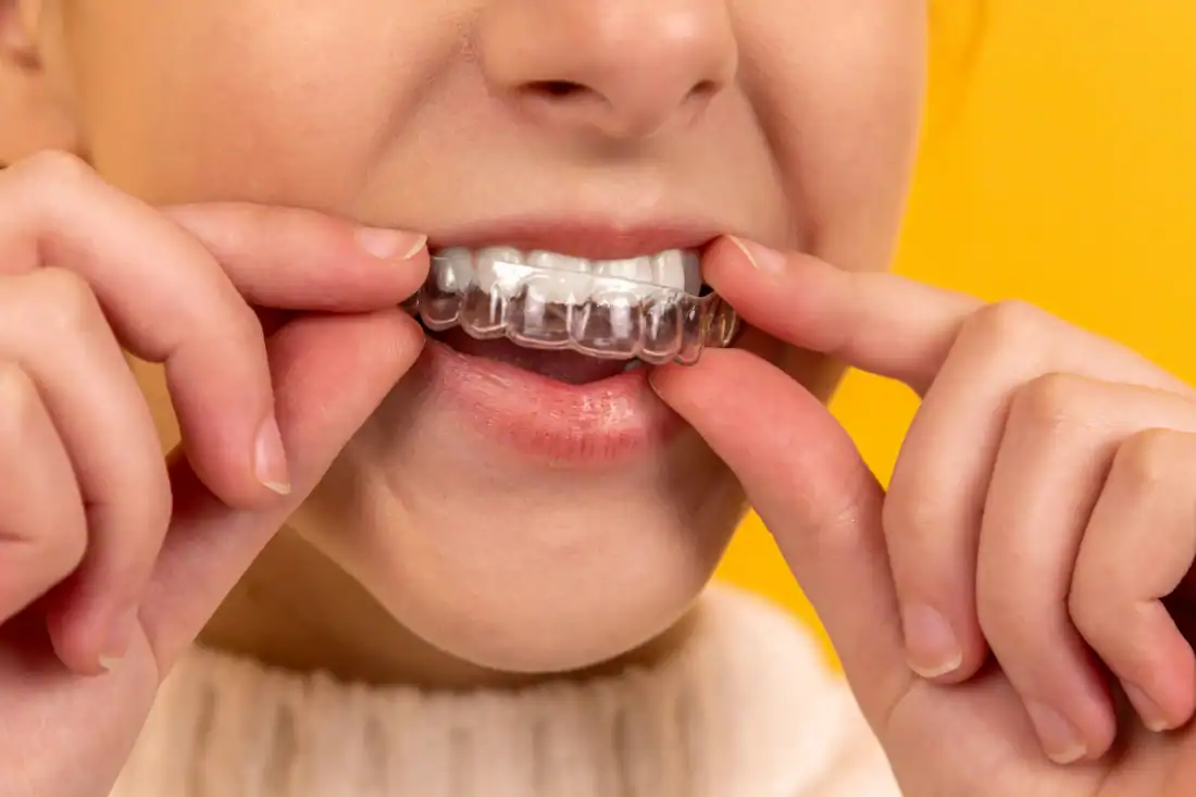 teen putting on her invisalign