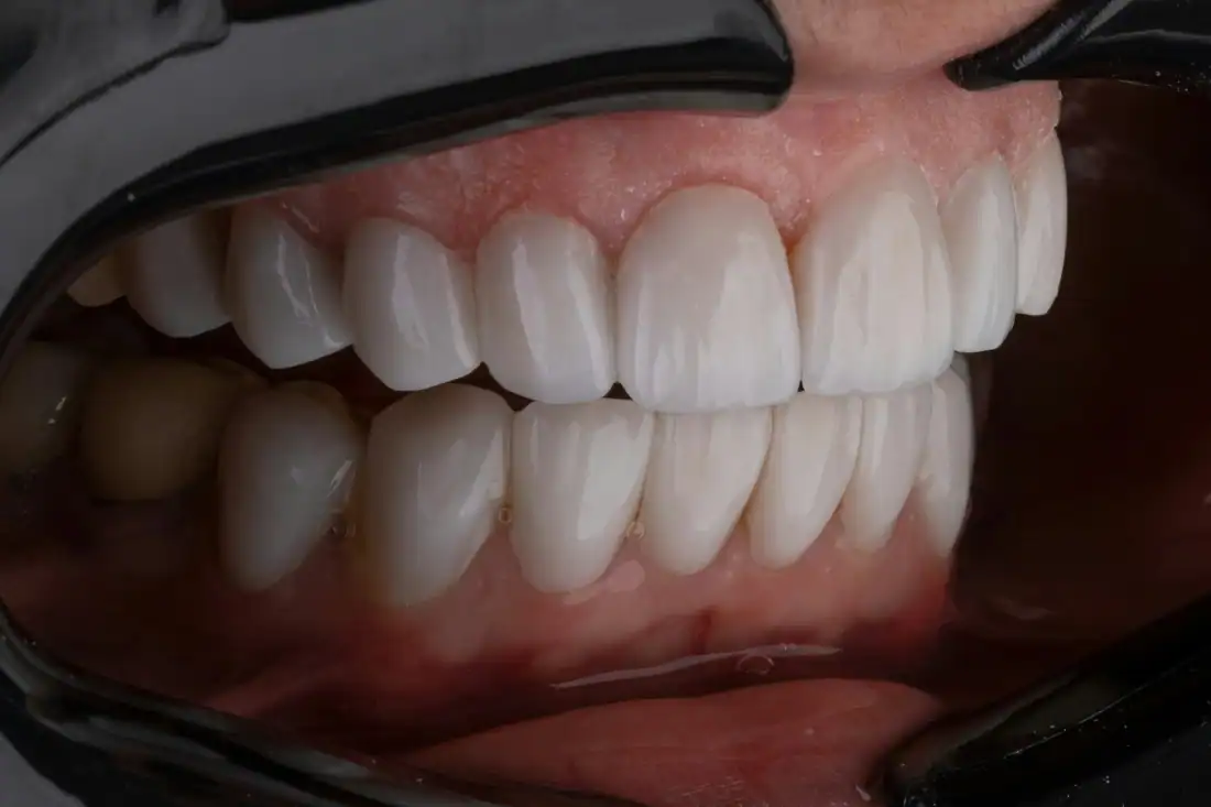 inflamed gums from periodontal disease