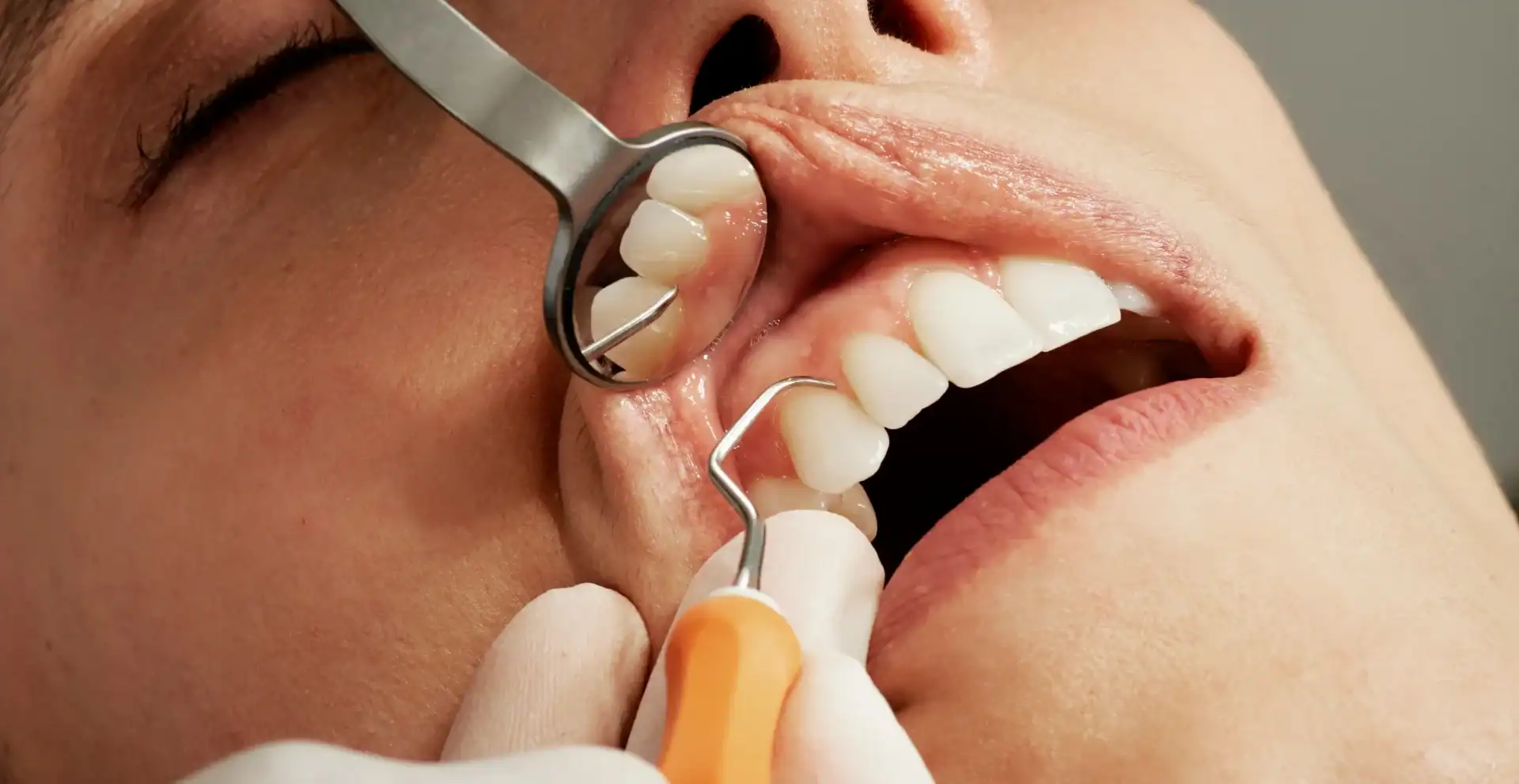 How Long After Teeth Cleaning Can I Eat? Essential Tips for Patients