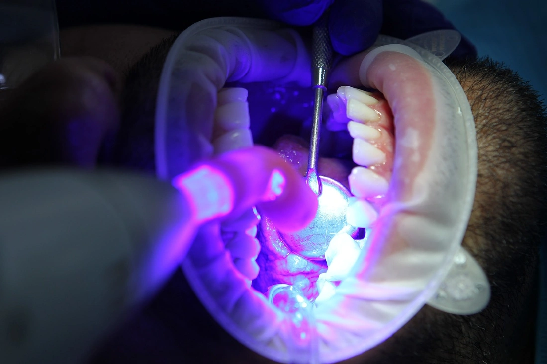 teeth whitening procedure