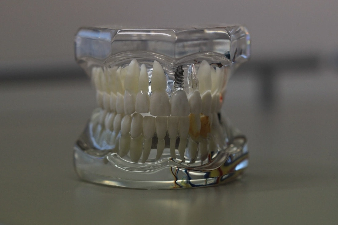 Dental implants model