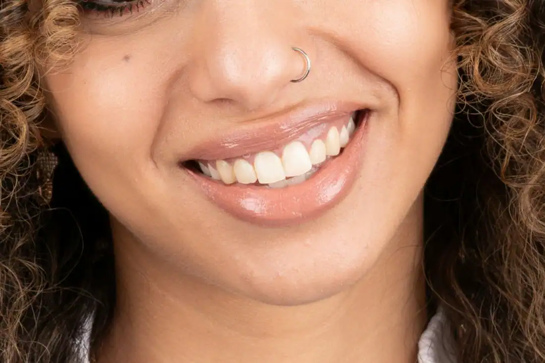 Woman with a veneer set that closely resembles other teeth.