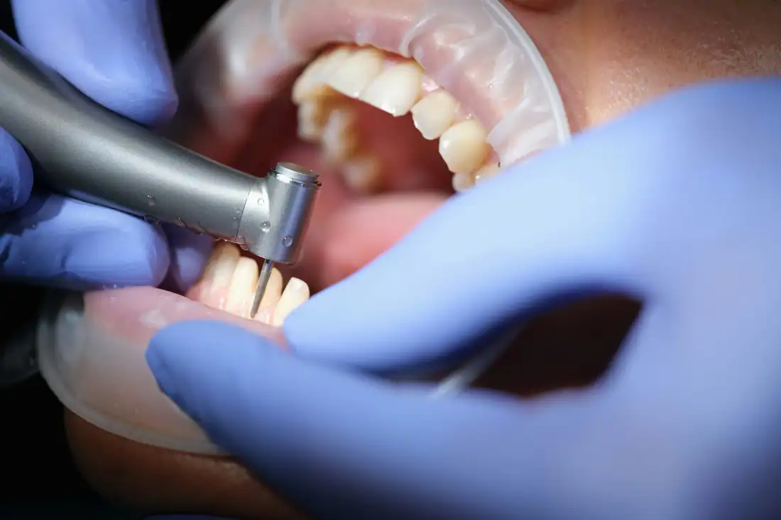 prepping teeth for veneers