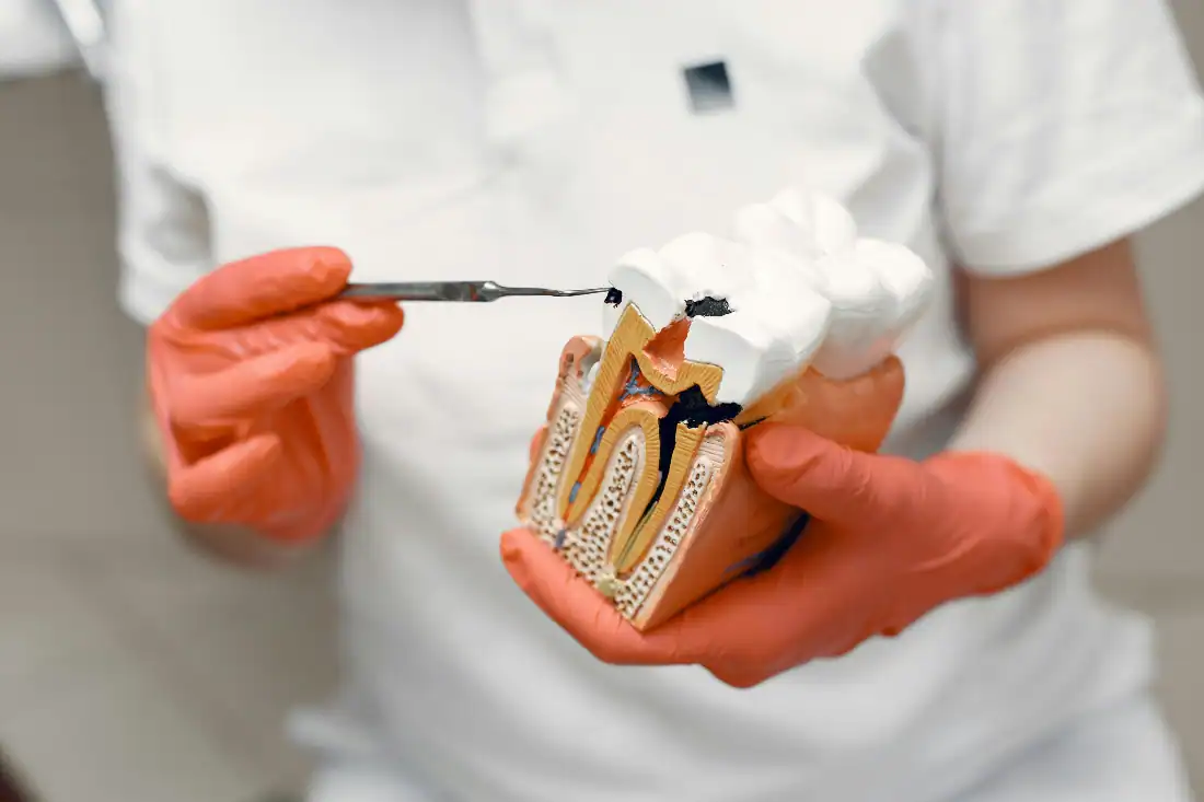 tooth model illustrating the root canal procedure