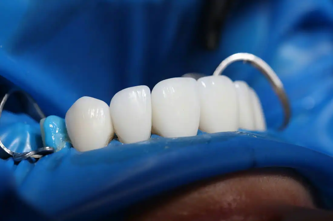 ceramic crowns