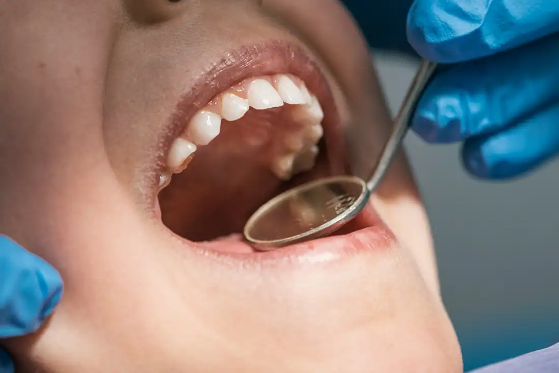 Poor oral hygiene can lead to periodontal disease.