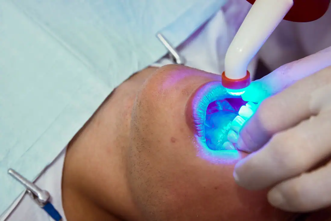 Lady gets a photopolymer filling