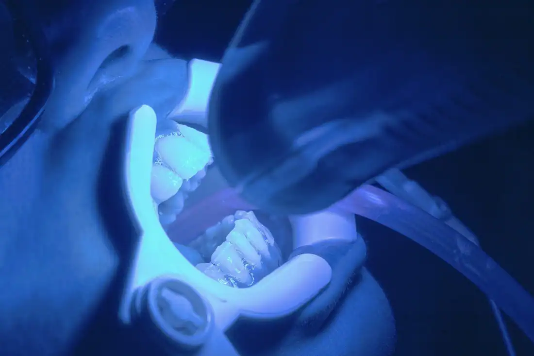 a close-up of a person doing a dental laser procedure