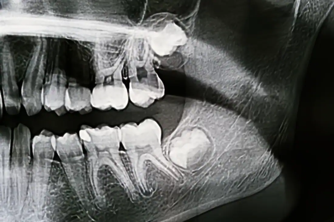 Panoramic X-ray of the jaw showing a wisdom tooth