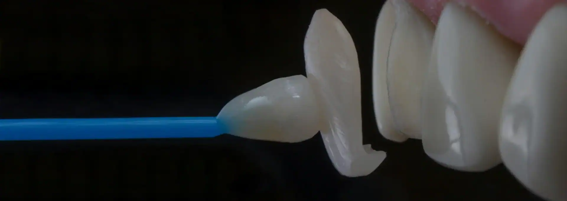 Teeth Bonding vs Veneers