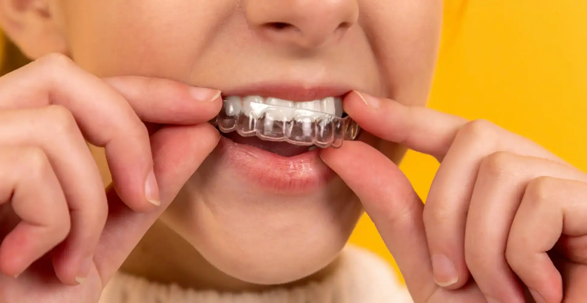 Top Benefits of Invisalign for Adults and Teens