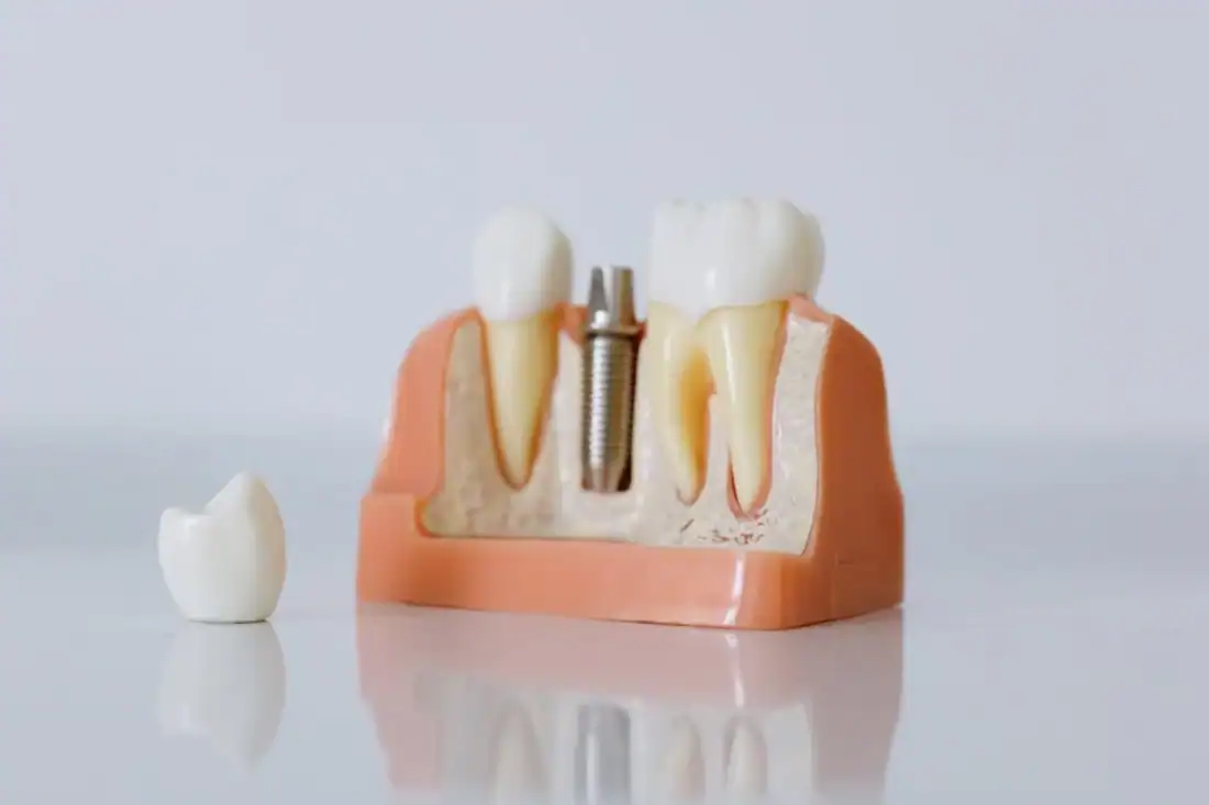 Close-up of a dental implant model featuring artificial teeth and jaw structure.