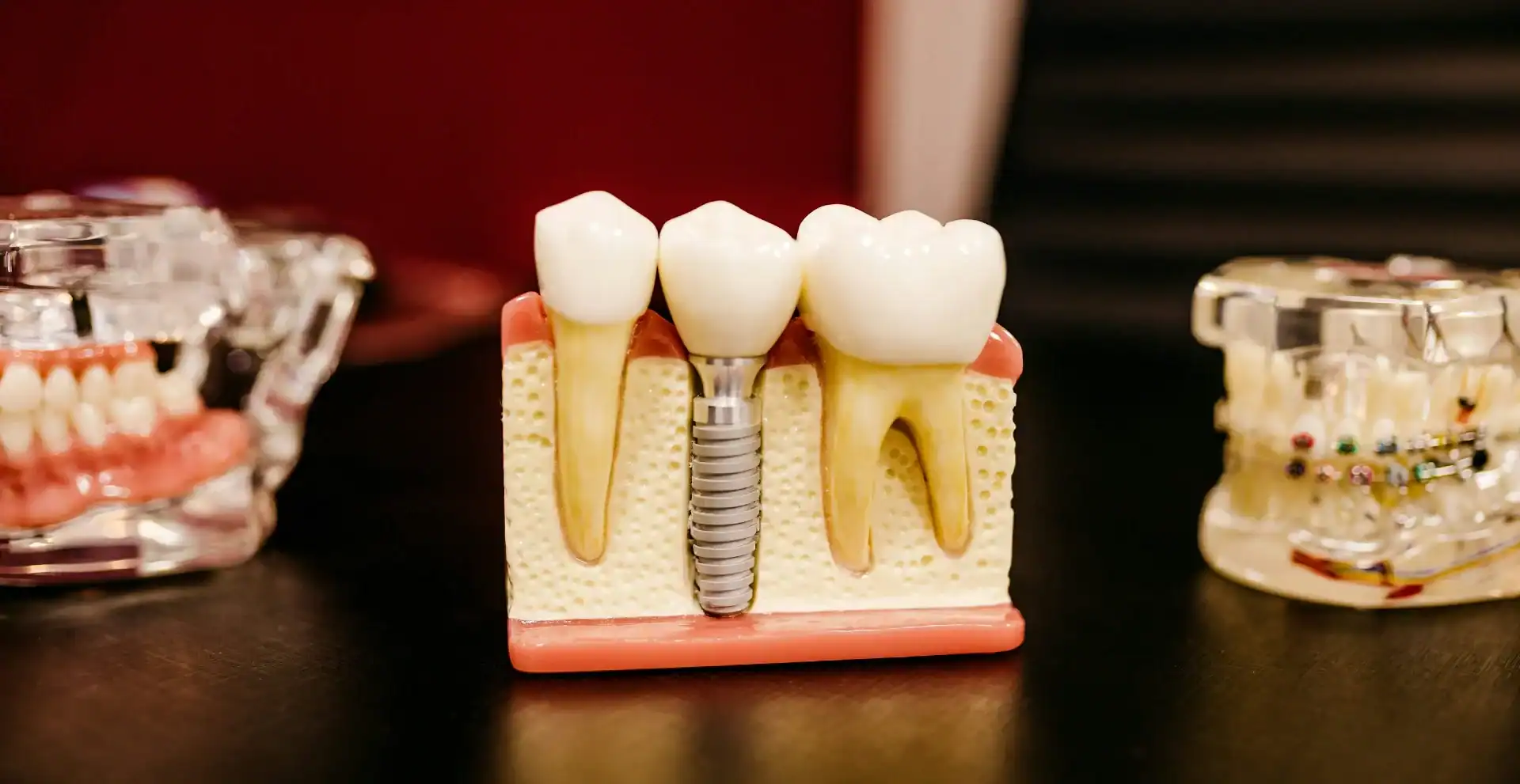 What Are Dental Implants Made Of
