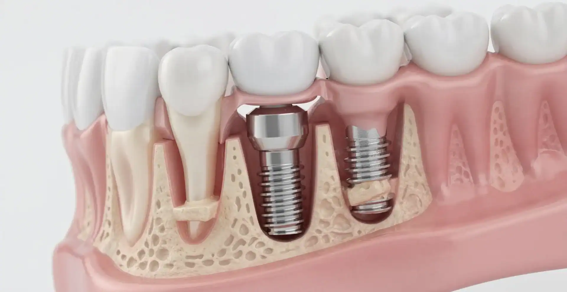 What Are The 3 Types Of Dental Implants