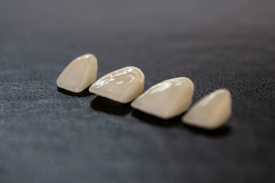 Porcelain veneers.