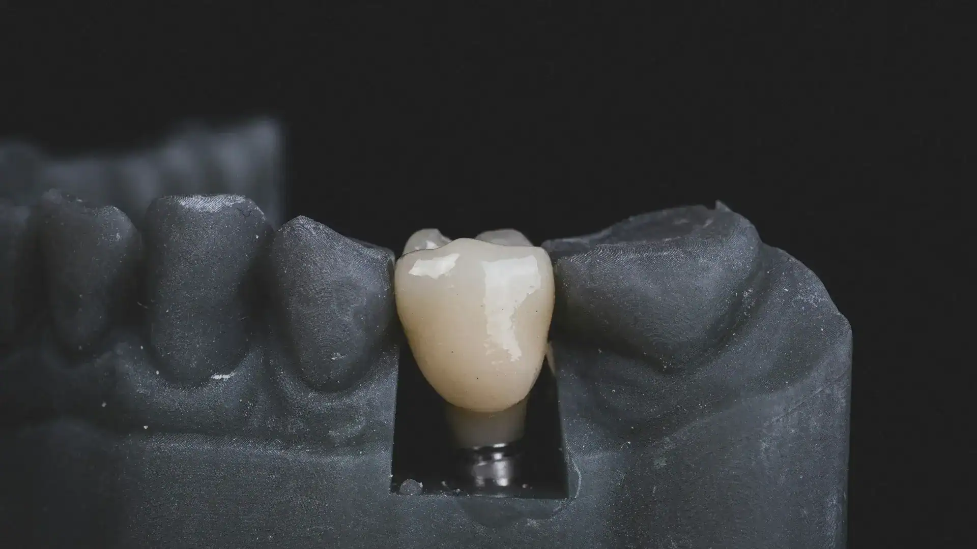 arch dental implants for missing teeth