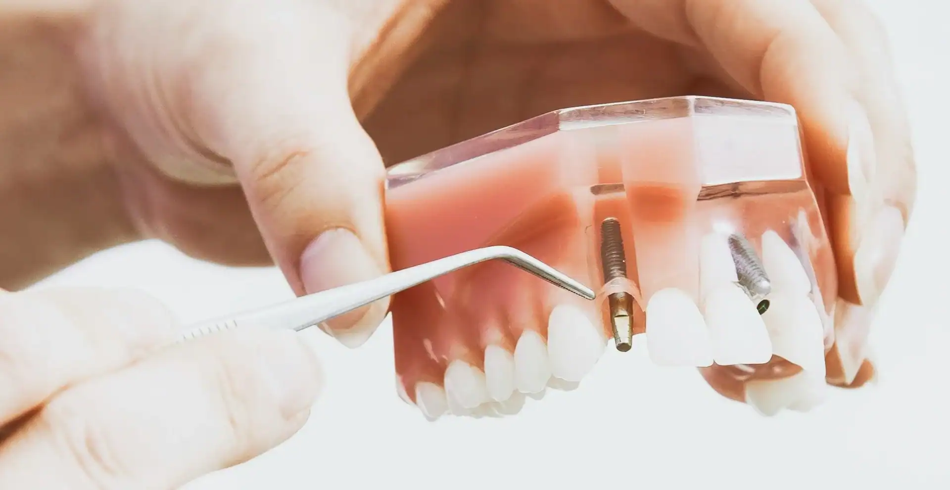 What Is an Arch in Dental Implants?