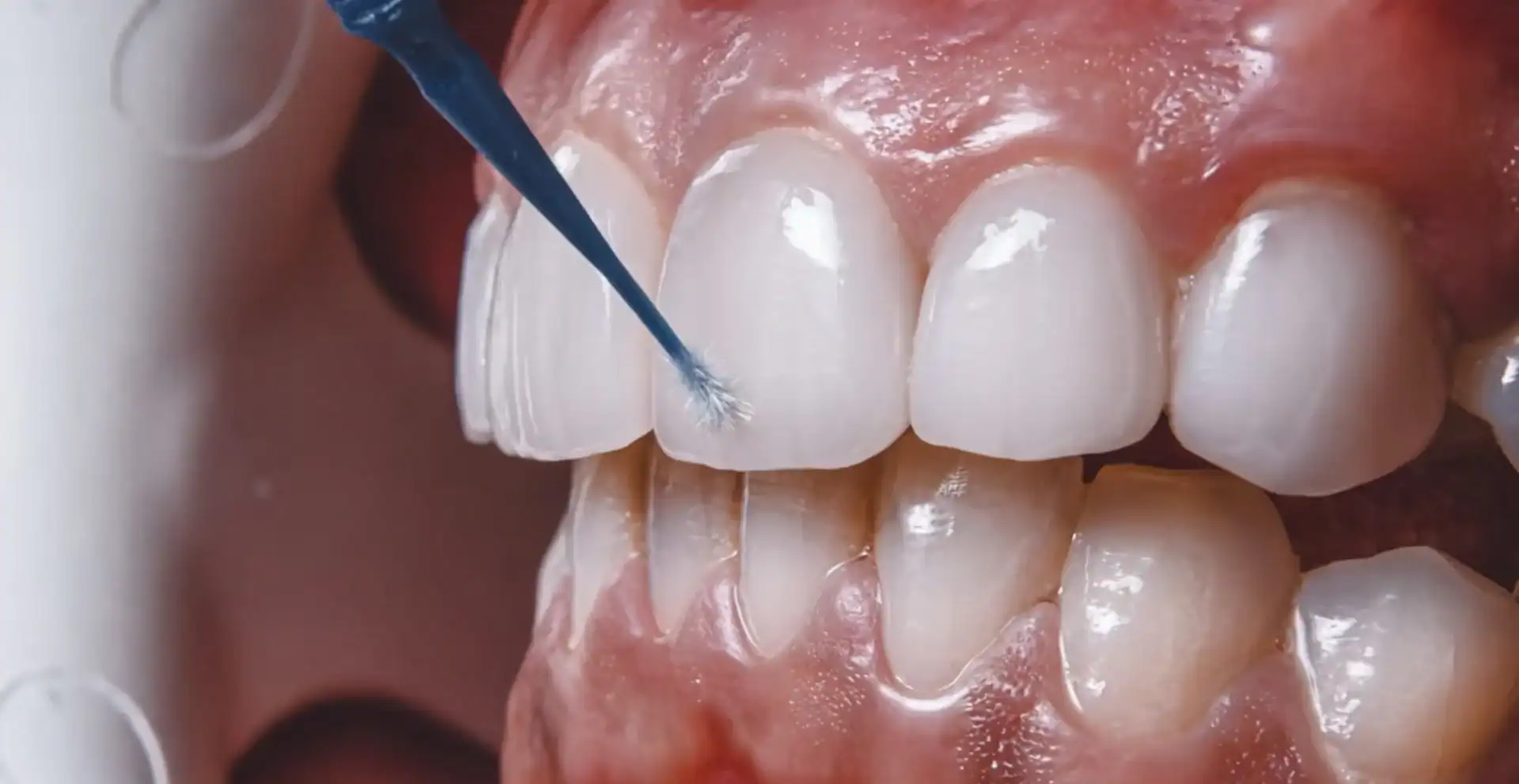 Why Are My Gums Red?