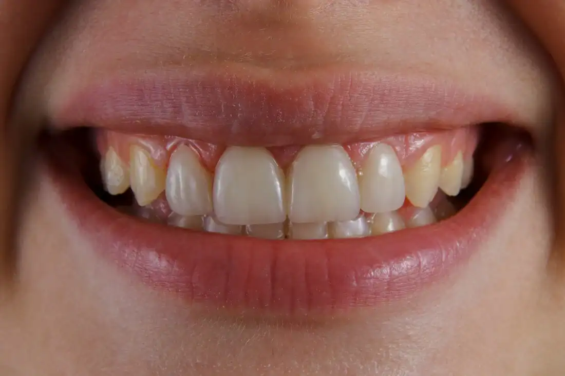 close-up of red, irritated gums