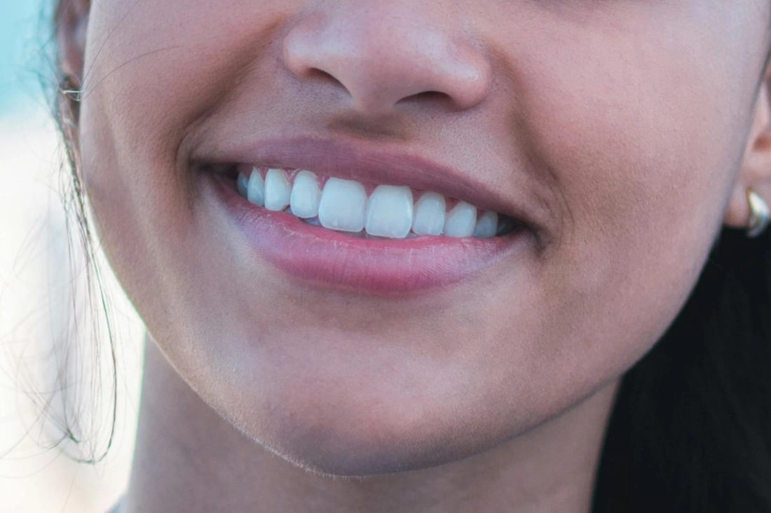 a woman smiling after using whitening strips