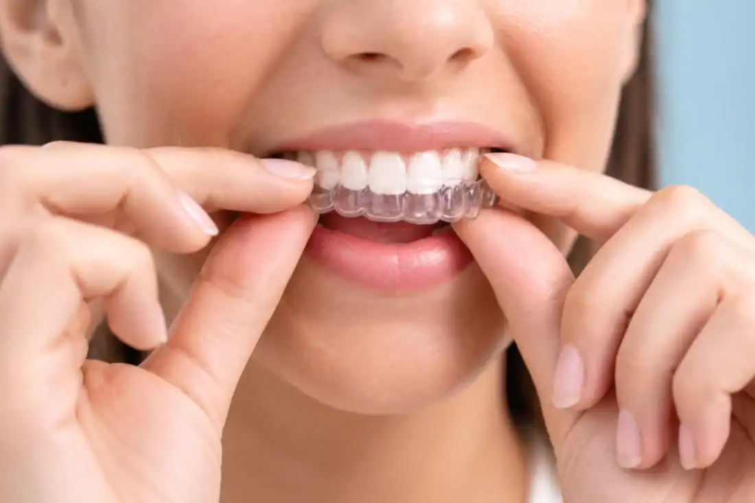 Woman adjusting clear dental aligners on teeth