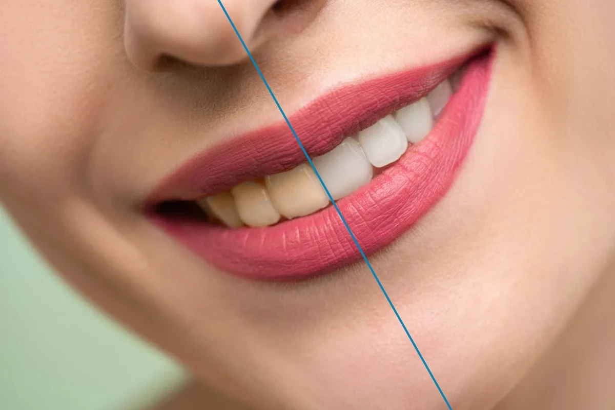 Yellowing Teeth