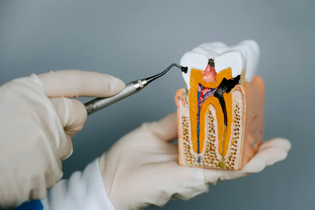 You get prescribe antibiotics after root canal