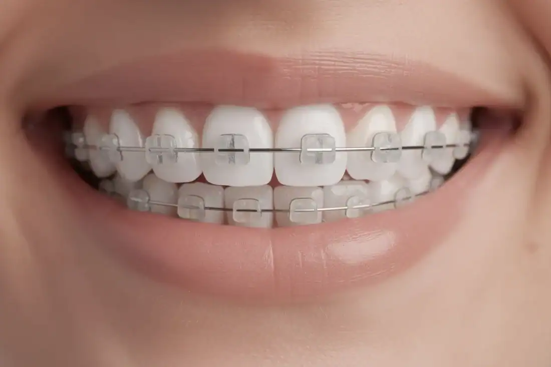 a close-up of ceramic braces