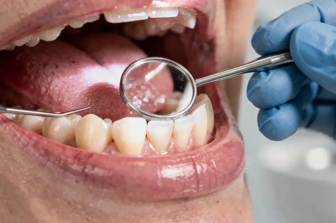 a dental hygienist closely examining a patient's teeth