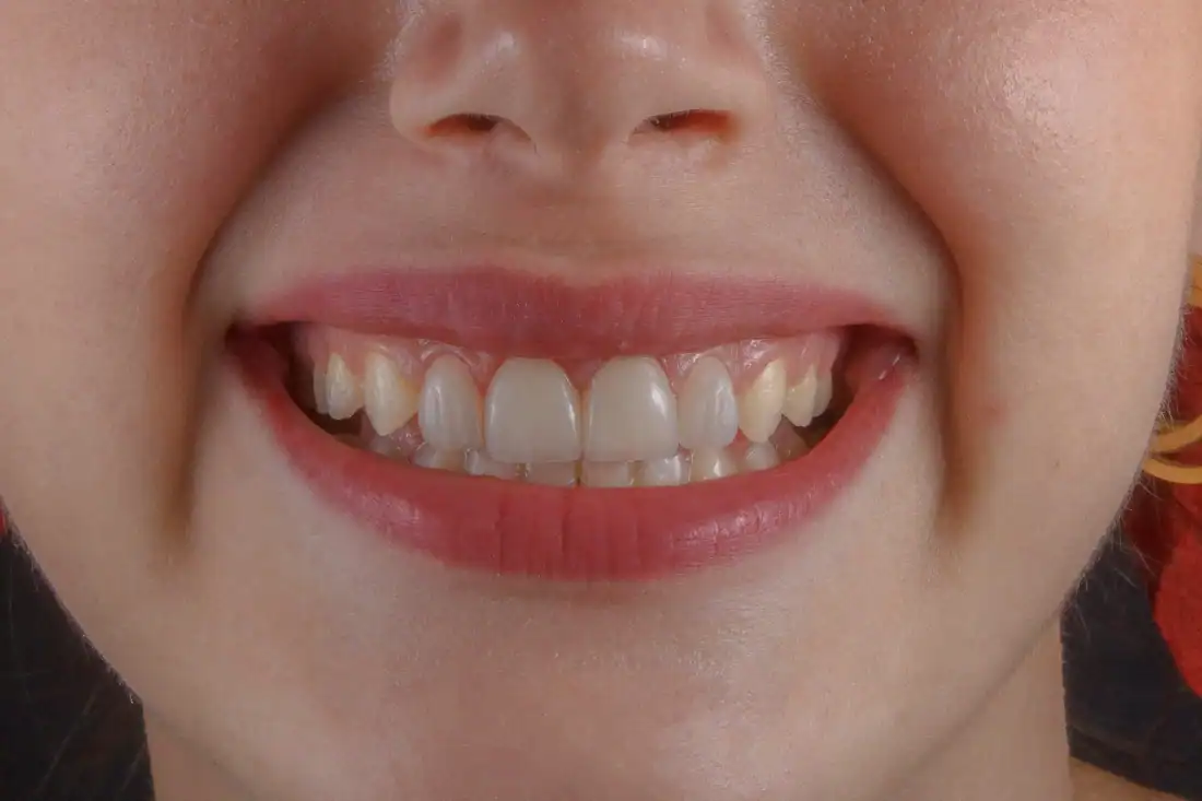 a woman smiling with nice set of teeth