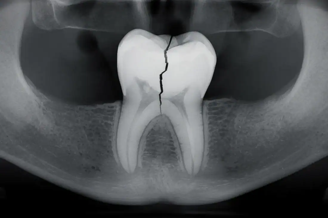 an X-ray view of a cracked tooth