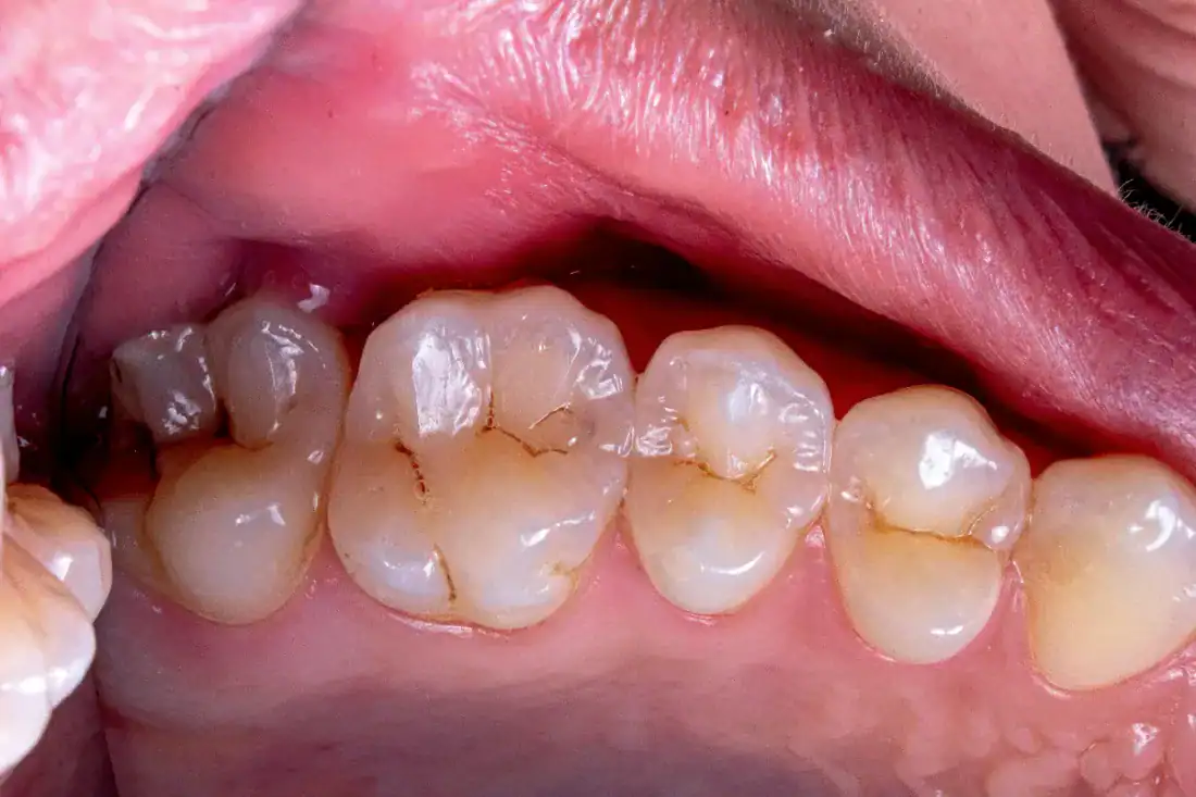 broken wisdom tooth