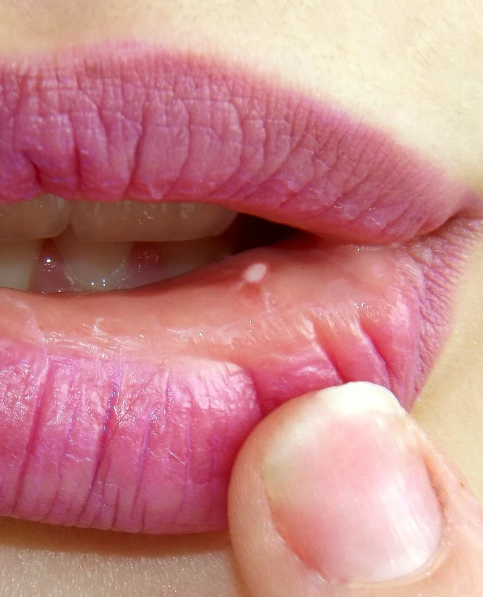 canker sores treatment in OKC