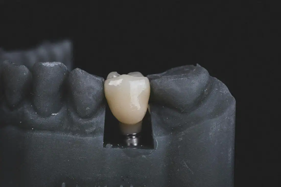ceramic crown