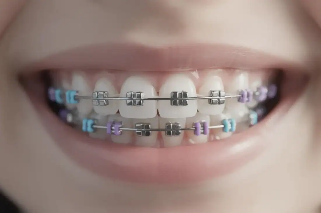 choose Dental Innovations for your teeth straightening journey