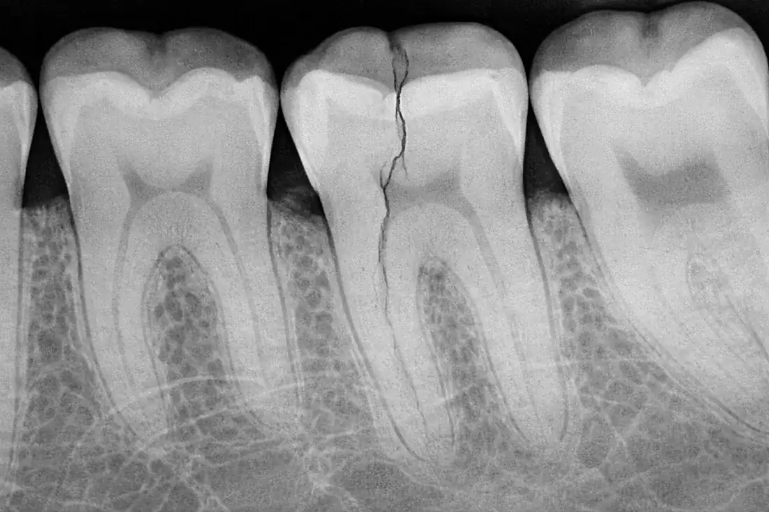 cracked molar x-ray close up